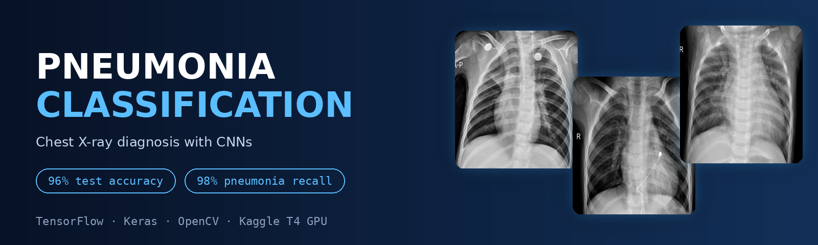 Pneumonia-Classification-CNN