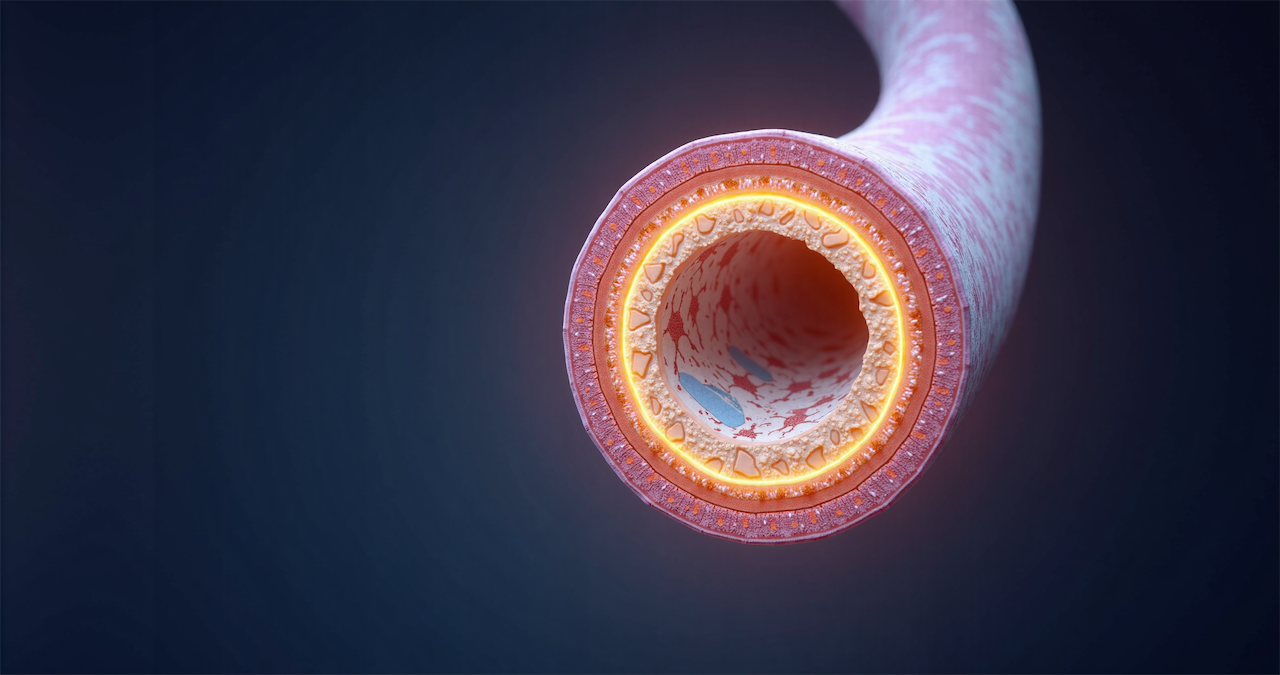 plaque-risk-explorer