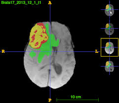 Automatic Brain Tumor Detection Using Convolutional Neural Networks