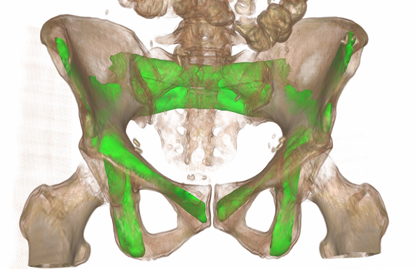 altas-of-pelvis-segmentation-and-trajectory-planning