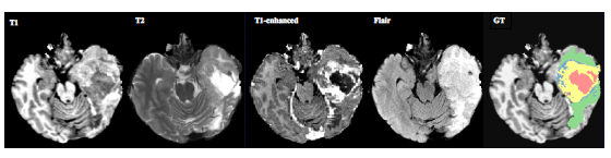 Brain-Tumor-Segmentation-Using-CNN