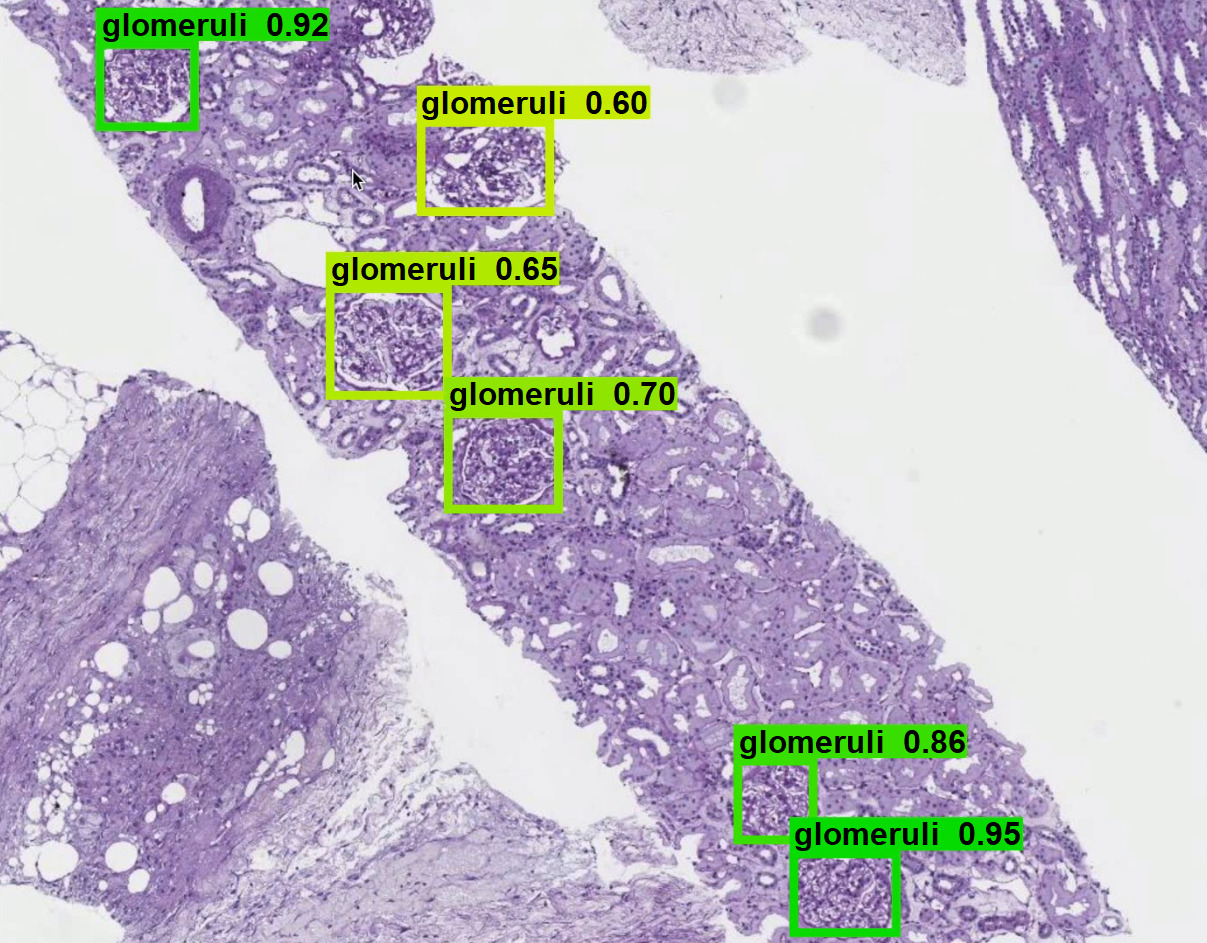 Real-time-detection-for-renal-pathology