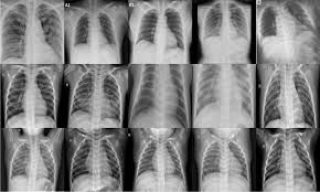 GitHub - gschandra5258/Deep-Learning-Image-Classification: Thoracic ...