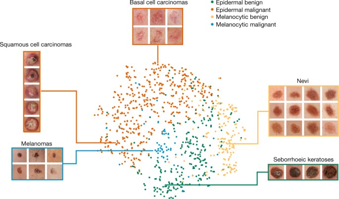 Github Mcachosoblechero Melanomadetection Deep Learning Pipeline For