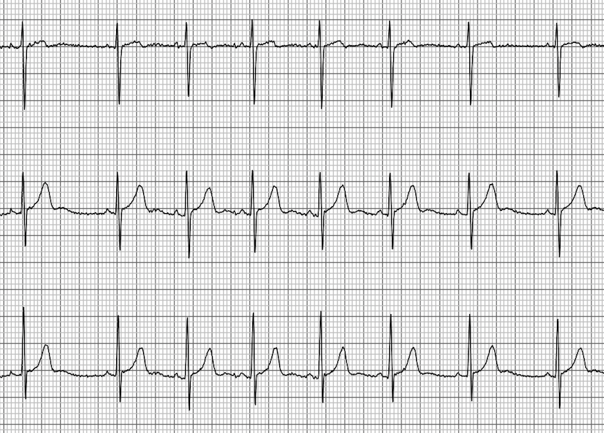 GitHub - antonior92/ecg-preprocessing