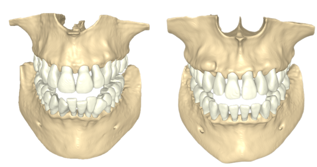 open-full-jaw