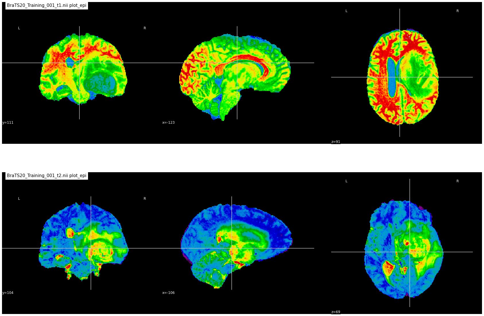 Brain-tumor-segmentation · GitHub Topics · GitHub