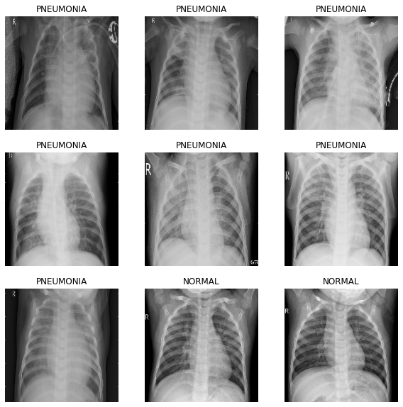 chest-xray-pneumonia-detection