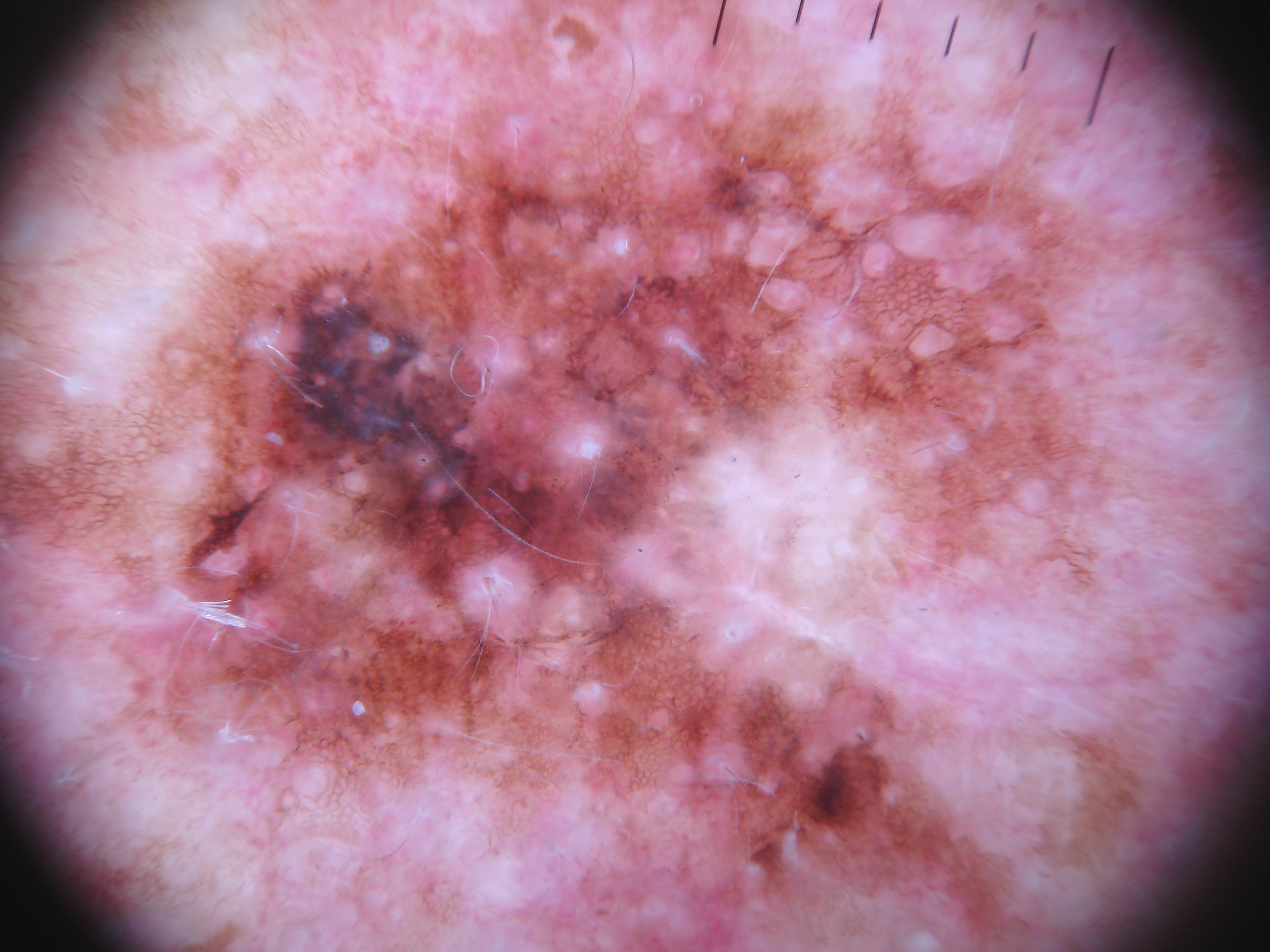 cnn--image-classification--melanoma