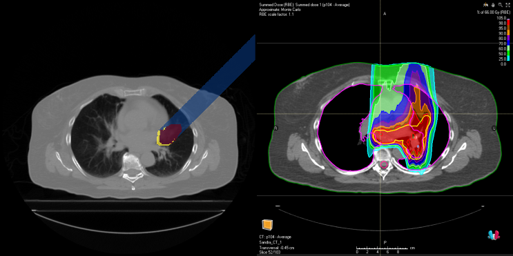 tailoring-proton-therapy-for-lung-cancer-a-new-approach-to-beam-angle-selection