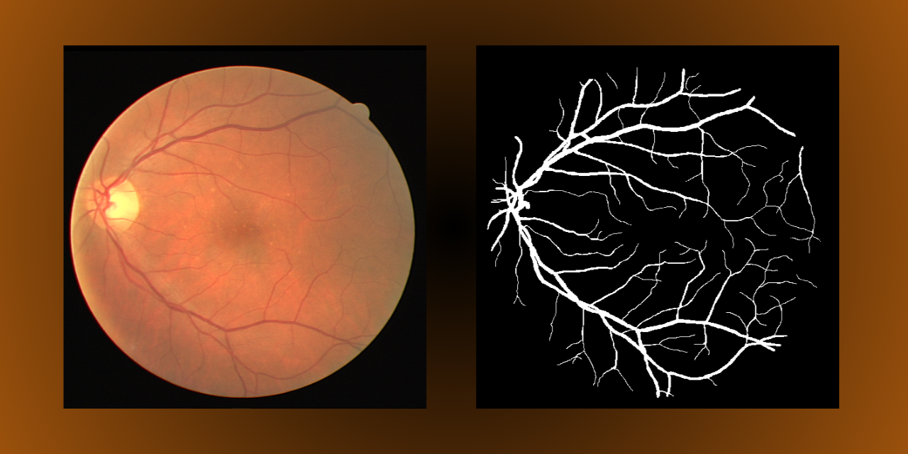 GitHub - Harshtherocking/retina-unet-segmentation: UNet based ...